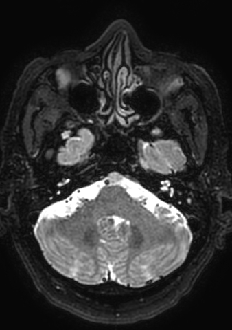 Accessory middle cerebral artery (Radiopaedia 73114-83828 Axial T2 172).jpg