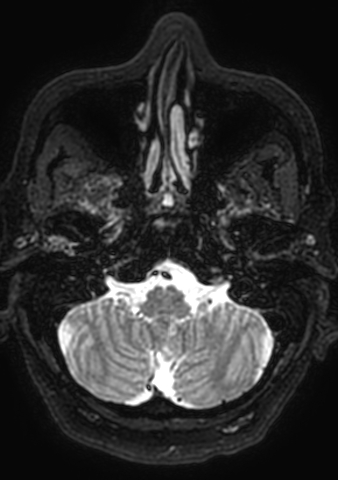 Accessory middle cerebral artery (Radiopaedia 73114-83828 Axial T2 189).jpg