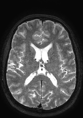 Accessory middle cerebral artery (Radiopaedia 73114-83828 Axial T2 46).jpg