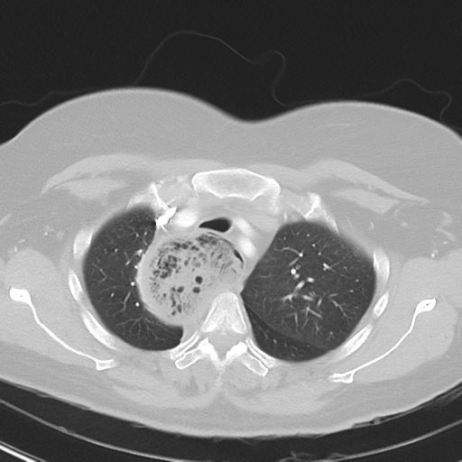 File:Achalasia (Radiopaedia 47147-51685 Axial lung window 12).png