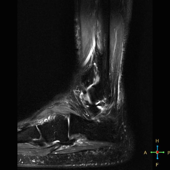 File:Achilles tendon complete tear (Radiopaedia 22834-22854 Sagittal STIR 3).jpg