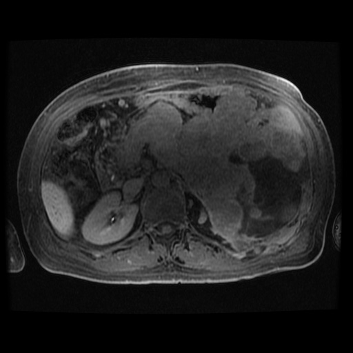 File:Acinar cell carcinoma of the pancreas (Radiopaedia 75442-86668 Axial late phase (~30 mins) 55).jpg