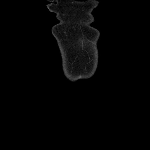 Acinar cell carcinoma of the pancreas (Radiopaedia 75442-86669 Coronal C+ portal venous phase 5).jpg