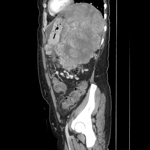 File:Acinar cell carcinoma of the pancreas (Radiopaedia 75442-86669 Sagittal C+ portal venous phase 139).jpg