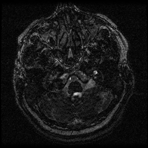 Acoustic schwannoma (Radiopaedia 33045-34060 Axial T2 1).png