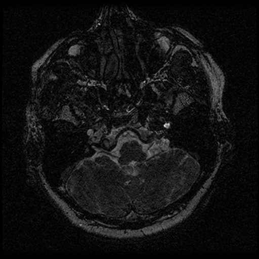 Acoustic schwannoma (Radiopaedia 33045-34060 Axial T2 7).png