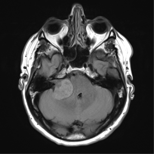 File:Acoustic schwannoma (Radiopaedia 50846-56358 Axial FLAIR 9).png
