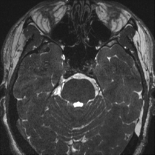 Acoustic schwannoma (translabyrinthine resection) (Radiopaedia 43570-46972 Axial CISS 45).png