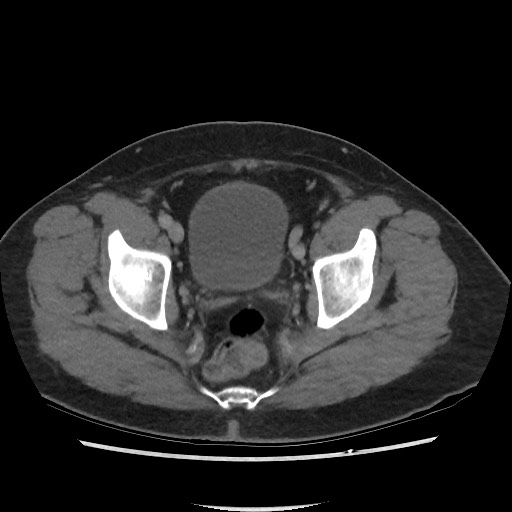 File:Active colonic bleed on CT (Radiopaedia 49765-55025 Axial C+ delayed 74).jpg