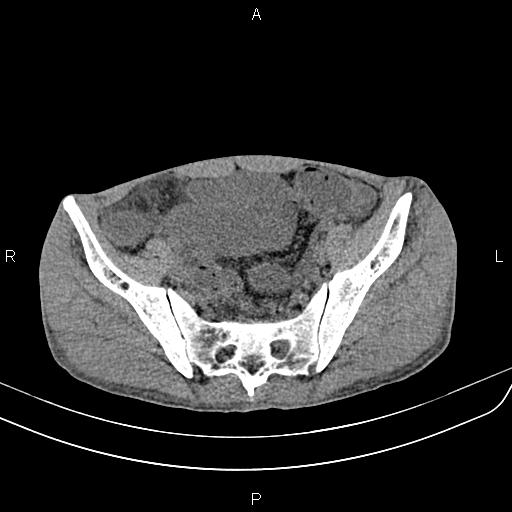 File:Active crohn disease (Radiopaedia 87133-103397 Axial non-contrast 82).jpg