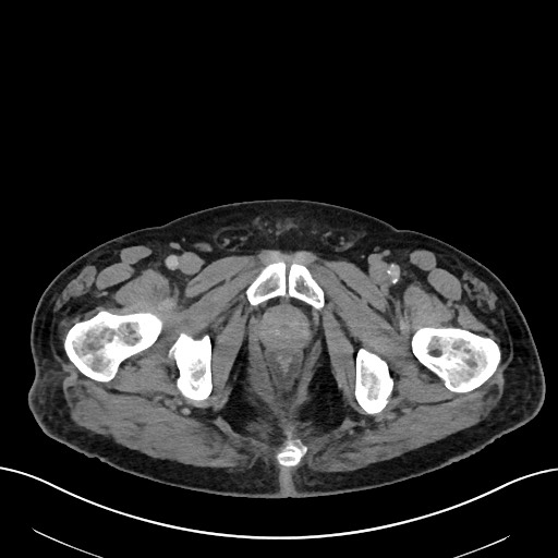 File:Active lower gastrointestinal bleeding - diverticular (Radiopaedia 61203-69106 Axial C+ portal venous phase 131).jpg