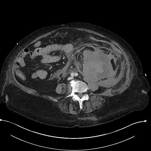 File:Active renal extravasation with large subcapsular and retroperitoneal hemorrhage (Radiopaedia 60975-68796 Axial 223).jpg