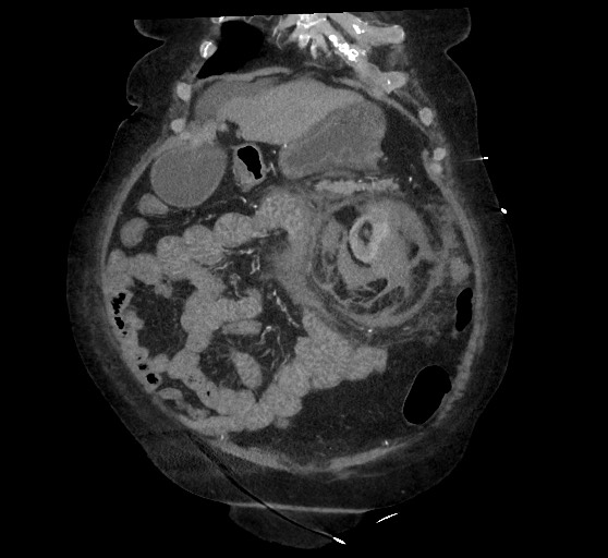 Active renal extravasation with large subcapsular and retroperitoneal hemorrhage (Radiopaedia 60975-68796 Coronal C+ arterial phase 44).jpg
