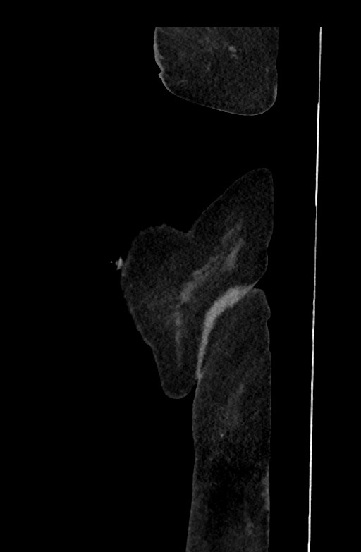 Active renal extravasation with large subcapsular and retroperitoneal hemorrhage (Radiopaedia 60975-68796 Sagittal C+ portal venous phase 220).jpg