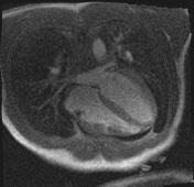 Active right ventricular cardiac sarcoidosis (Radiopaedia 55596-62100 Axial Dynamic perfusion scan MOCO 99).jpg