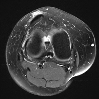 File:Acute-on-chronic transient lateral patellar dislocation with trochlear dysplasia (Radiopaedia 84099-99349 Axial PD fat sat 21).jpg