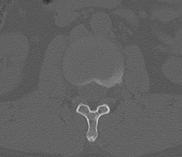 File:Acute L1 burst compression fracture (Radiopaedia 34430-35755 Axial bone window 28).png