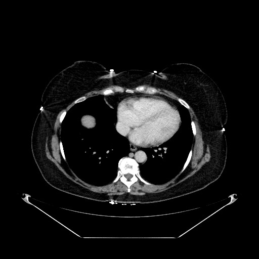 File:Acute appendicitis, heterotaxy syndrome (Radiopaedia 66884-76202 Axial 137).jpg