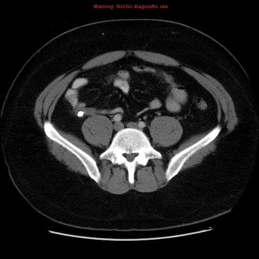 File:Acute appendicitis (Radiopaedia 12326-12607 Axial C+ portal venous phase 25).jpg
