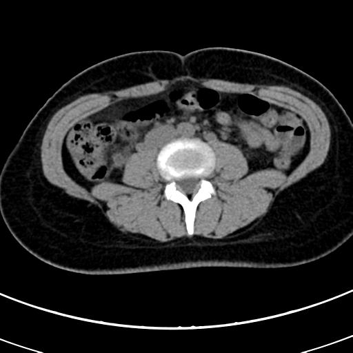 Acute appendicitis (Radiopaedia 30261-30888 Axial non-contrast 45).jpg