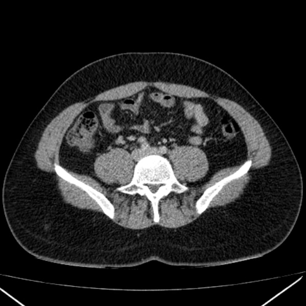Acute appendicitis (Radiopaedia 38255-40270 Axial C+ portal venous phase 70).jpg