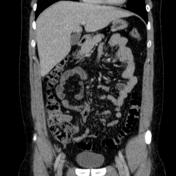 Acute appendicitis (Radiopaedia 38255-40270 Coronal C+ portal venous phase 33).jpg