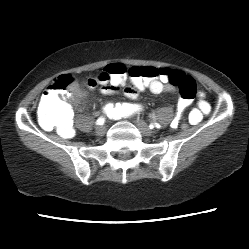 File:Acute appendicitis (Radiopaedia 52672-58589 Axial C+ arterial phase 14).jpg