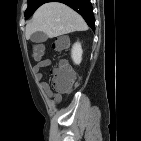 Acute appendicitis (Radiopaedia 66513-75790 Sagittal C+ portal venous phase 32).jpg