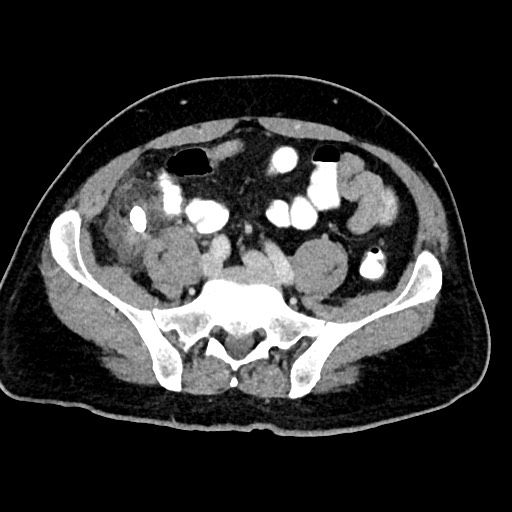 Acute appendicitis (Radiopaedia 77016-88960 Axial C+ portal venous phase 101).jpg