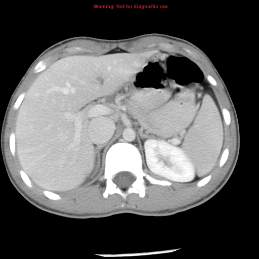 Acute appendicitis (Radiopaedia 8195-9045 Axial C+ portal venous phase 18).jpg