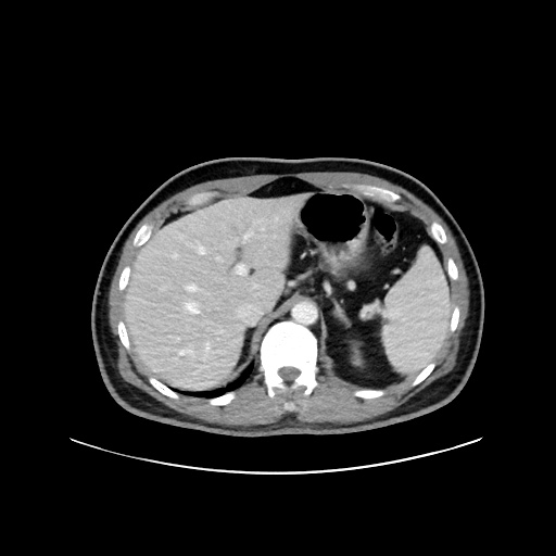 Acute appendicitis and COVID 19 pneumonia (Radiopaedia 76604-88380 Axial C+ portal venous phase 19).jpg