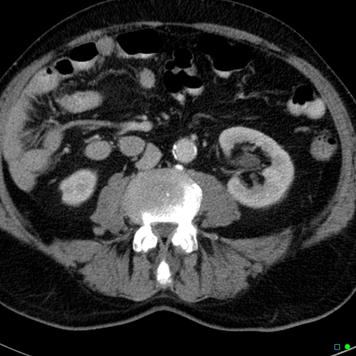 File:Acute appendicitis arising from a malrotated cecum (Radiopaedia 19970-19997 Axial C+ portal venous phase 17).jpg