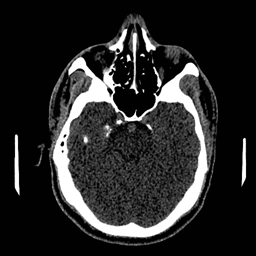 Acute basilar artery occlusion (Radiopaedia 43582-46985 Axial non-contrast 68).jpg