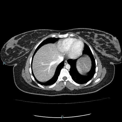 Acute bilateral pyelonephritis (Radiopaedia 37146-38881 Axial C+ portal venous phase 5).jpg