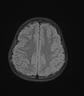 File:Acute cerebellar ataxia (Radiopaedia 61487-69446 Axial FLAIR 16).jpg