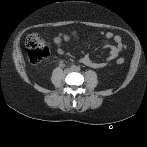 Acute cholecystitis and ureteric colic (Radiopaedia 42330-45444 Axial prone 61).jpg