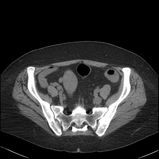 Acute colonic hemorrhage in ulcerative colitis (Radiopaedia 77415-89538 Axial non-contrast 104).jpg