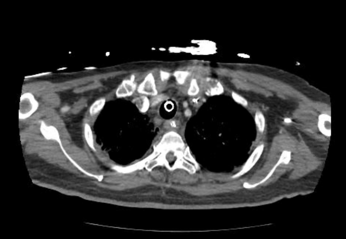 Acute cor pulmonale (ultrasound) (Radiopaedia 83508-98818 Axial C+ CTPA 8).jpg