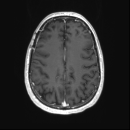 Acute disseminated encephalomyelitis (ADEM) (Radiopaedia 65319-74350 Axial T1 C+ 45).png