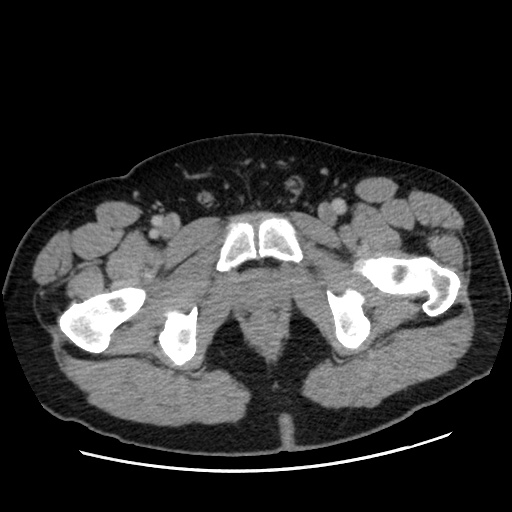 Acute diverticulitis with localized perforation (Radiopaedia 41296-44113 Axial C+ portal venous phase 93).jpg