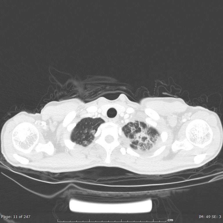 Acute eosinophilic pneumonia (Radiopaedia 48211-53073 Axial lung window 4).jpg