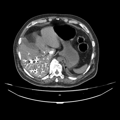Acute heart failure (CT) (Radiopaedia 79835-93075 Axial C+ arterial phase 74).jpg