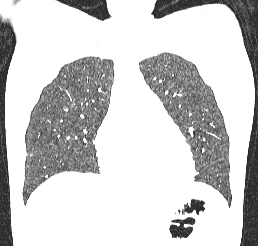 File:Acute hypersensitivity pneumonitis (Radiopaedia 85293-100870 Coronal lung window 35).jpg