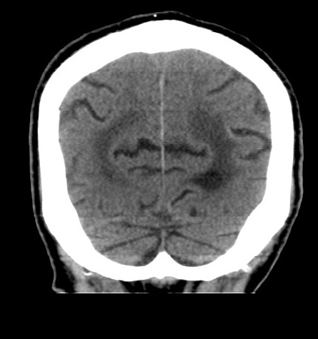 Acute left anterior cerebral artery territory infarction (Radiopaedia 51785-57578 Coronal non-contrast 49).jpg