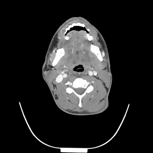 Acute longus colli calcific tendinitis (Radiopaedia 72495-83036 Axial C+ arterial phase 41).jpg
