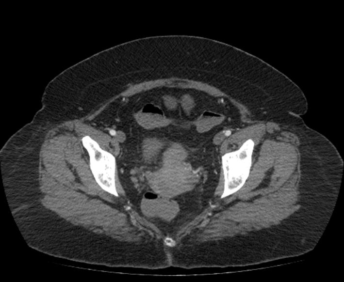 Acute mesenteric ischemia (Radiopaedia 80029-93316 Axial C+ arterial phase 120).jpg