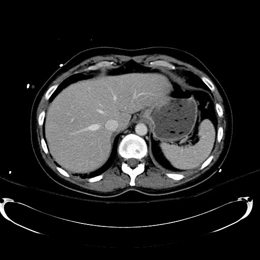 Acute myocardial infarction in CT (Radiopaedia 39947-42415 Axial C+ portal venous phase 24).jpg
