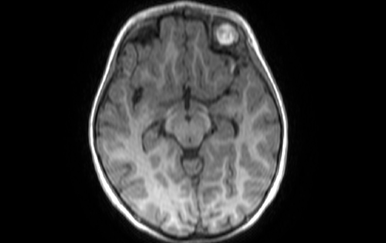 Acute necrotizing encephalitis of childhood (Radiopaedia 67356-76737 Axial T1 56).jpg
