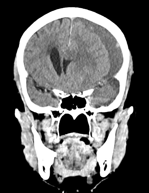Acute on chronic subdural hematoma (Radiopaedia 74814-85823 Coronal non-contrast 26).jpg