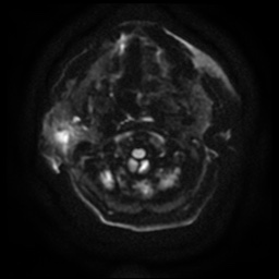 File:Acute otitis externa (Radiopaedia 57296-64236 Axial DWI 11).jpg